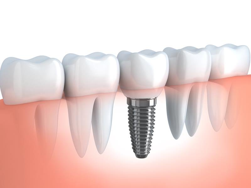 Dental Implants Oakland, NJ