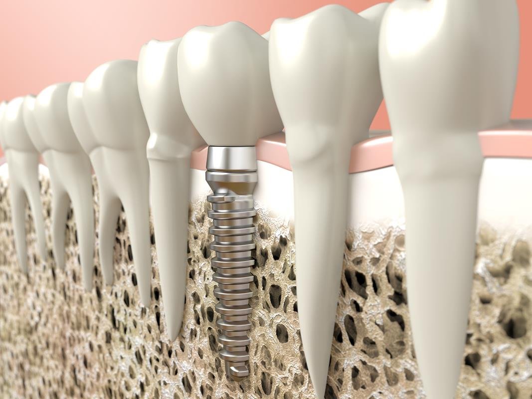 Dental Implants Oakland, NJ